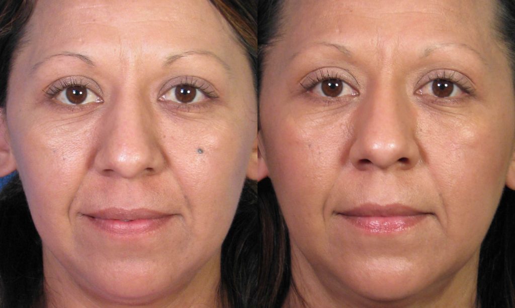 Mole Removal After Care – 3 Tips To Keep Your Skin Looking As Sexy As Possible Mole Removal After Care – 3 Tips To Keep Your Skin Looking As Sexy As Possible